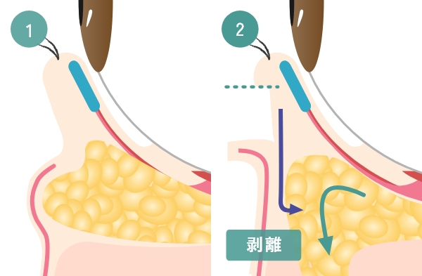 皮膚切除＋眼窩脂肪切除