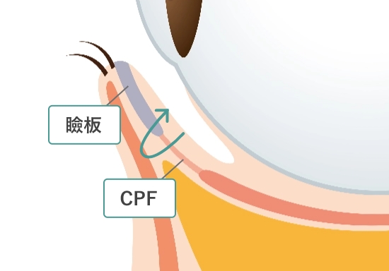 糸をCPFと瞼板に通します。