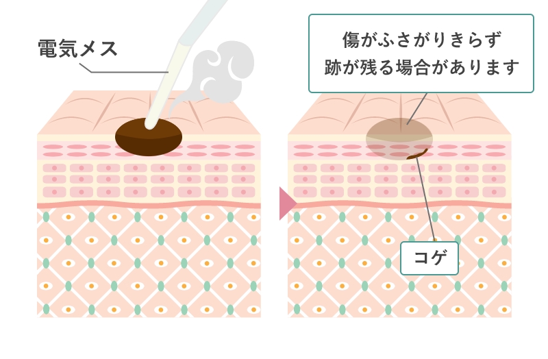 電気メスによる除去(電気分解法)
