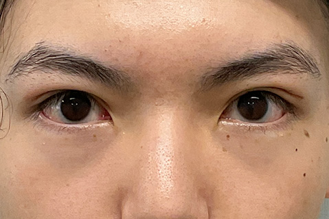 眼瞼下垂：術後