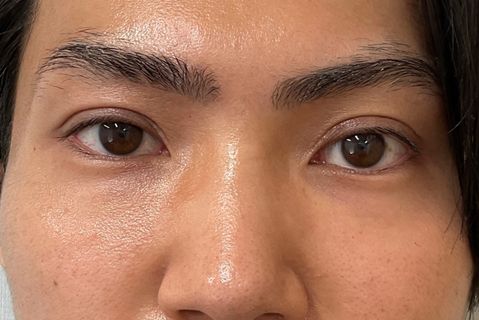 眼瞼下垂：術後