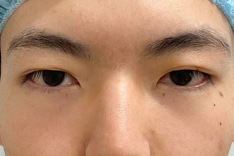 眼瞼下垂：術前