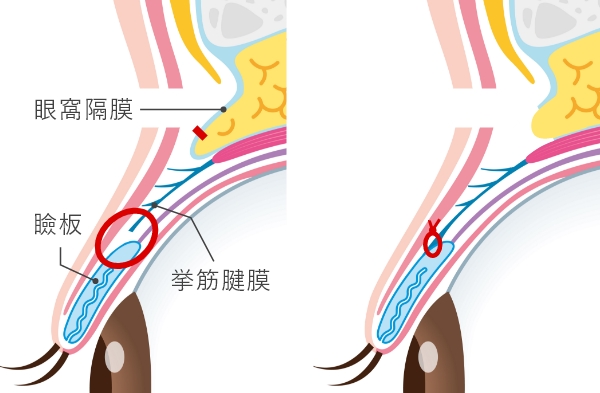 眼瞼挙筋前転法(松尾法）での治療