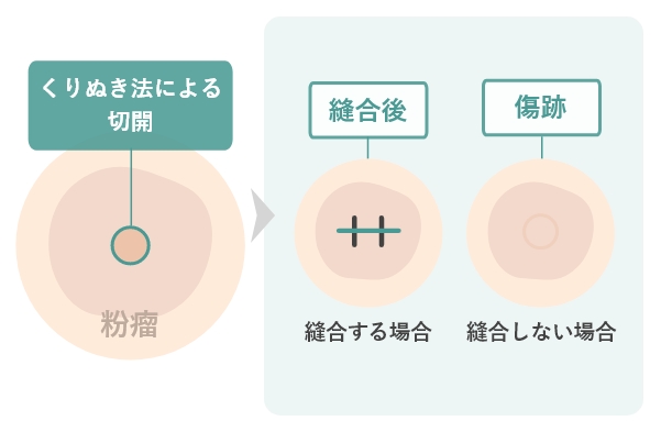 くりぬき法による切開