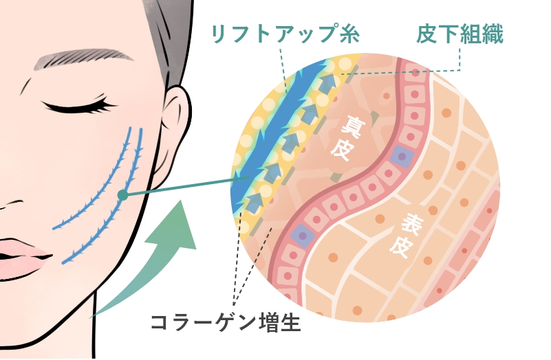 糸リフト治療の特徴と効果